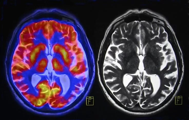 MRI scans of the brain